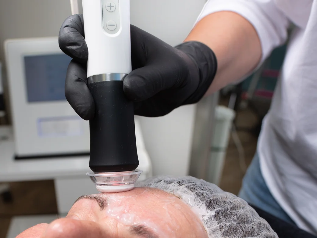 Microdermabrasion – Nahaufnahme der Behandlung