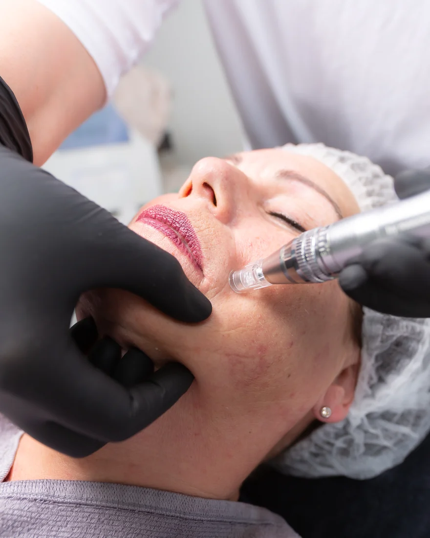 Microneedling Behandlung im Studio – Astrid Panitz, Kaarst