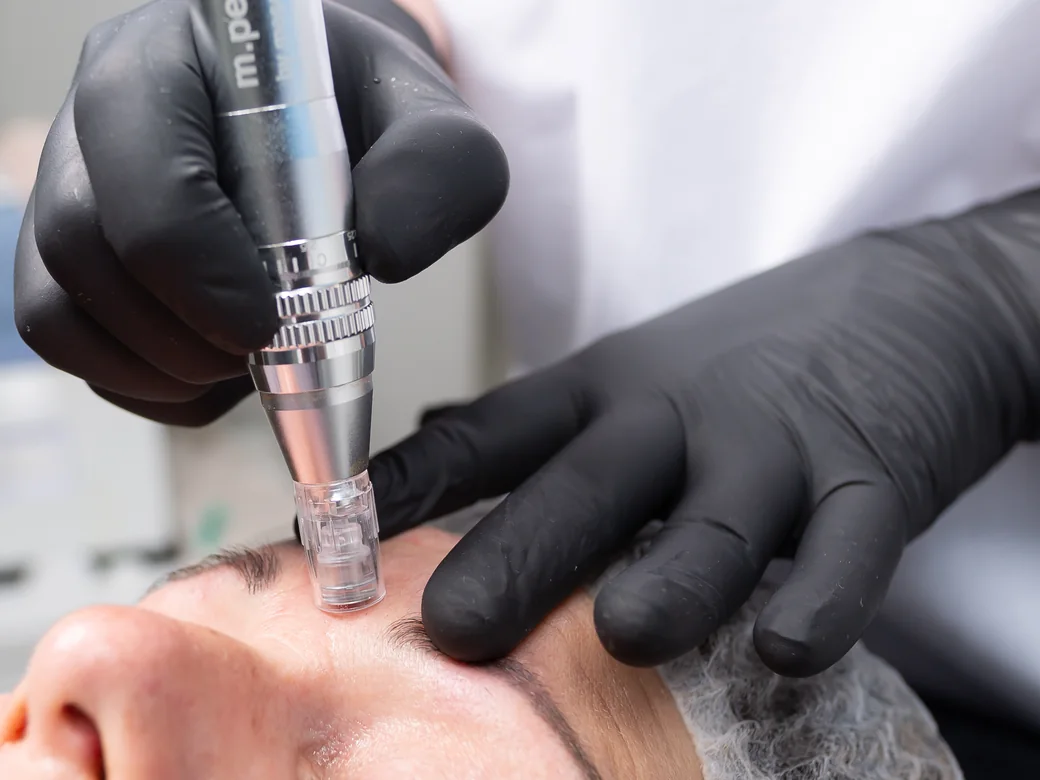 Microneedling – Nahaufnahme der Behandlung